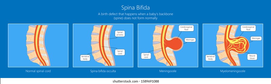 Spina Bifida Birth Defects Infant Disease Neural Tube Pregnant