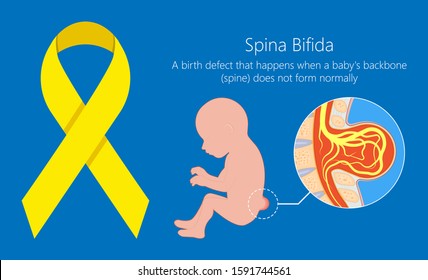 Spina Bifida Birth Defects Infant Disease Neural Tube Pregnant