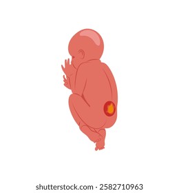 Spina, Bifida, Disability Vector Illustration Isolated