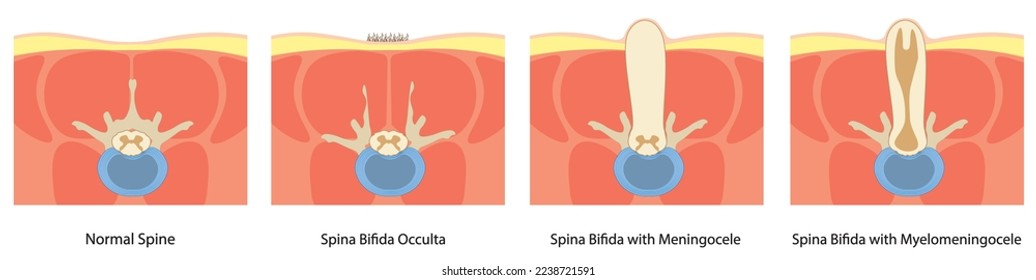 Spina Bifida illustration in a Cross view. normal spine, meningocele and meningomyelocele