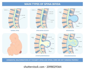 Spina Bifida Pregnancy Non Invasive Neural Tube Gene AFP NTD Infant Cord Folate Folic Acid Serum Level Sacral Dimple Child Lumbar Birth NIPT Test Fetus Born Baby Spine Blood Fluid Villus Alpha