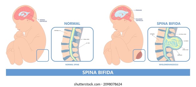 Spina Bifida Pregnancy Non Invasive Neural Tube Gene AFP NTD Infant Cord Folate Folic Acid Serum Level Sacral Dimple Child Lumbar Birth NIPT Test Fetus Born Baby Spine Blood Fluid Villus Alpha