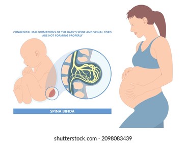 Spina Bifida Pregnancy Non Invasive Neural Tube Gene AFP NTD Infant Cord Folate Folic Acid Serum Level Sacral Dimple Child Lumbar Birth NIPT Test Fetus Born Baby Spine Blood Fluid Villus Alpha