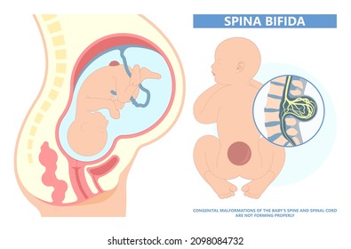 Spina Bifida Pregnancy Non Invasive Neural Tube Gene AFP NTD Infant Cord Folate Folic Acid Serum Level Sacral Dimple Child Lumbar Birth NIPT Test Fetus Born Baby Spine Blood Fluid Villus Alpha