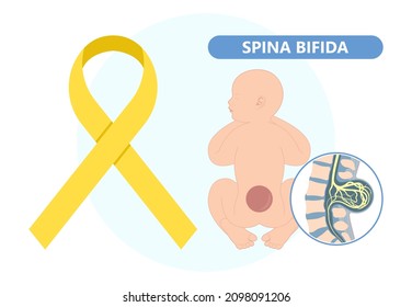 Spina Bifida Pregnancy Non Invasive Neural Tube Gene AFP NTD Infant Cord Folate Folic Acid Serum Level Sacral Dimple Child Lumbar Birth NIPT Test Fetus Born Baby Spine Blood Fluid Villus Alpha