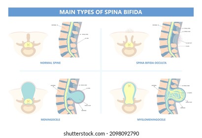 Spina Bifida Pregnancy Non Invasive Neural Tube Gene AFP NTD Infant Cord Folate Folic Acid Serum Level Sacral Dimple Child Lumbar Birth NIPT Test Fetus Born Baby Spine Blood Fluid Villus Alpha