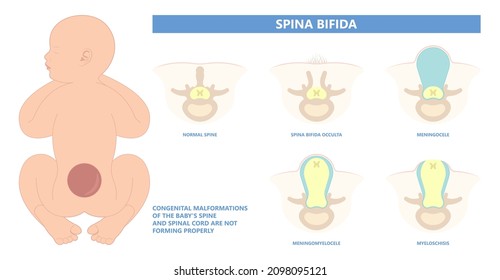 Spina Bifida Pregnancy Non Invasive Neural Tube Gene AFP NTD Infant Cord Folate Folic Acid Serum Level Sacral Dimple Child Lumbar Birth NIPT Test Fetus Born Baby Spine Blood Fluid Villus Alpha