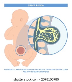 Spina Bifida Pregnancy Non Invasive Neural Tube Gene AFP NTD Infant Cord Folate Folic Acid Serum Level Sacral Dimple Child Lumbar Birth NIPT Test Fetus Born Baby Spine Blood Fluid Villus Alpha