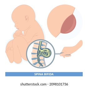 Spina Bifida Pregnancy Non Invasive Neural Tube Gene AFP NTD Infant Cord Folate Folic Acid Serum Level Sacral Dimple Child Lumbar Birth NIPT Test Fetus Born Baby Spine Blood Fluid Villus Alpha