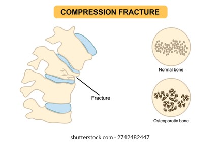 spinal compression fracture. Vertebral compression fracture, back pain, osteoporosis. Vector flat illustration for medical, clinical, or educational posters.