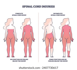 Spinal cord injuries with complete or incomplete trauma outline diagram. Labeled educational scheme with function or feeling zones in state of paralysis vector illustration. Medical neural condition.