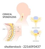 Spinal cord pinched nerves and painful Tingling Numbness hand of thoracic neck root injury outlet pain damage spine canal syndrome degeneration Herniation traumatic bone disk spurs