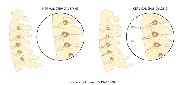 Spinal Cord Pinched Nerves And Painful Tingling Numbness Hand Of Thoracic Neck Root Injury Outlet Pain Damage Spine Canal Syndrome Degeneration Herniation Traumatic Bone Disk Spurs