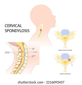 Spinal cord pinched nerves and painful Tingling Numbness hand of thoracic neck root injury outlet pain damage spine canal syndrome degeneration Herniation traumatic bone disk spurs