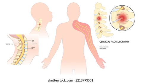 Spinal Cord Pinched Nerves And Painful Tingling Numbness Hand Of Thoracic Neck Root Injury Outlet Pain Damage Spine Canal Syndrome Degeneration Herniation Traumatic Bone Disk Spurs