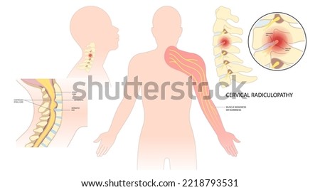 Spinal cord pinched nerves and painful Tingling Numbness hand of thoracic neck root injury outlet pain damage spine canal syndrome degeneration Herniation traumatic bone disk spurs
