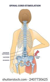 Spinal cord stimulation device for chronic back pain relief outline diagram. Labeled educational scheme with medical procedure to help patients after spinal trauma or injury vector illustration.