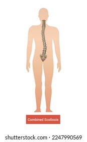 Spinal curvature scoliosis composition with anatomic view of human body silhouette with spine and text vector illustration