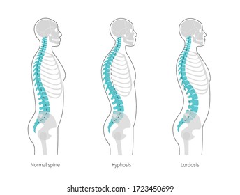 Spinal deformity flat vector illustration. Kyphosis, lordosis of spine infographics. Diagram with spine curvatures and healthy backbone. Body posture defect. Medical, educational and science banner.