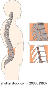 Spinal deformity flat vector illustration. Kyphosis, lordosis and scoliosis of spine infographics.. Body posture defect. Medical, educational and science banner