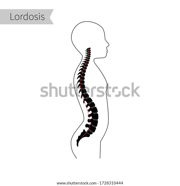 Spinal Deformity Flat Vector Illustration Lordosis Stock Vector Royalty Free