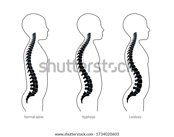 Spinal Deformity Flat Vector Illustration Kyphosis Stock Vector ...