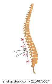 Spinal deformity. Symbol of spine curvatures or unhealthy backbones. Human spine anatomy, curved spine. Diagram with marked section. Body posture defect