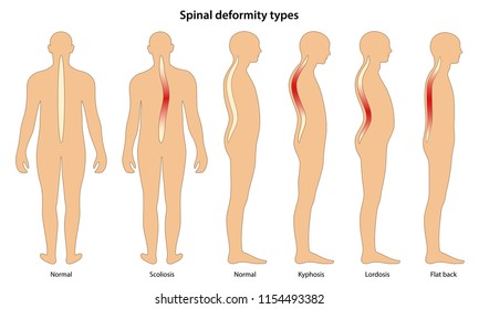 Spinal Deformity Types. Anterior View And Lateral View. Vector Illustration