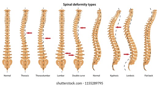 Spinal Deformity Types. Anterior View And Lateral View. Vector Illustration