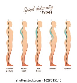 Spinal deformity types. Diseases of the spine.Lordosis, kyphosis, round back, flat back. Vector human silhouettes for your design