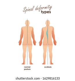 Spinal deformity types. Diseases of the spine.scoliosis and normal posture. Vector human silhouettes. For your design