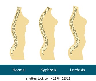 spinal deformity types, health concept