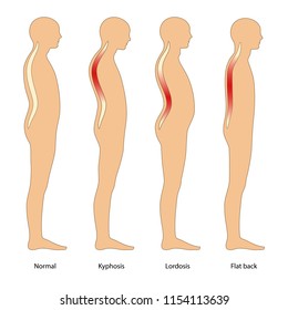 Spinal Deformity Types. Lateral View. Vector Illustration