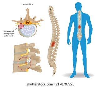 Herniación del disco espinal. Dolor de espalda humano. Compresión de la médula espinal. Disco de carga. Ortopédico