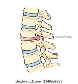 Schaltbild der Spinalscheibenherniation, Vektorgrafik. Illustration in der Medizin