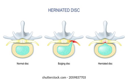 Spinal disc herniation. Difference Between Bulging disc and Herniated Disc. Vector illustration
