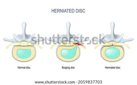 Spinal disc herniation. Difference Between Bulging disc and Herniated Disc. Vector illustration Stock photo © 