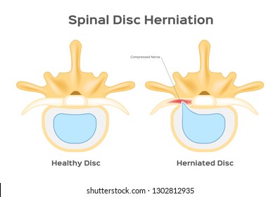 Spinal Disc Herniation / Human Back Infographic Vector