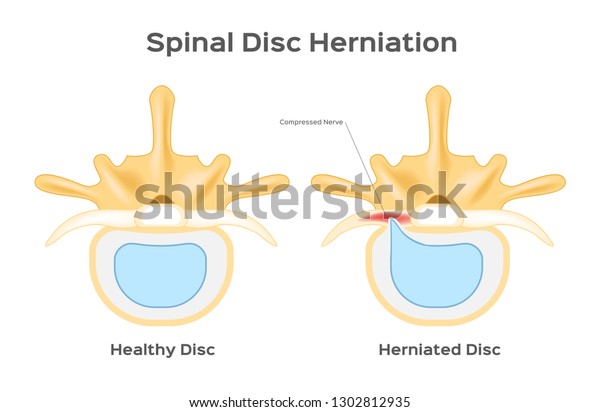 Spinal Disc Herniation Human Back Infographic Stock Vector (Royalty ...