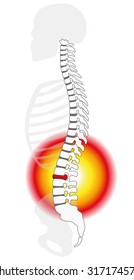 Spinal disc herniation or prolapse at a human vertebral column - profile view. Isolated vector illustration on white background.