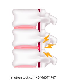 Spinal disc herniation vector illustration