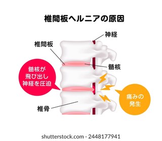 Spinal disc herniation vector illustration. Translation: Spinal disc herniation, Spinal code, Disc, Nucleus pulposus, Vertebral body, Herniated disc, Compressed nerve root. 