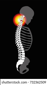 Spinal disc prolapse - neck pain caused by cervical vertebrae - profile view. Isolated vector illustration on black background.