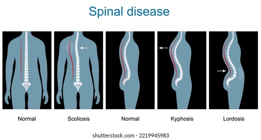 Enfermedad medular. tipos de defectos de la columna vertebral. Esqueleto humano y huesos. Trastornos de la columna vertebral. Deformidad normal de la columna vertebral y de la escoliosis a Lordosis y Kyphosis. Ilustración vectorial como x-Ray