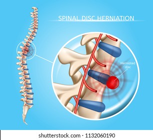 Spinal Disk Herniation Vector Medical Scheme with Vertebral Column and Herniated Disc Anatomical Illustration on Blue Background. Chronic Spinal and Neck Pain Causes, Spine Joints Diseases Concept