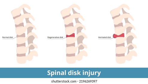 Rückenmarksverletzung.	Die hernisierte Scheibe verursacht Schmerzen, Taubheit oder Schwäche, und die degenerative Scheibe führt zu trockenen oder riskanten Ergebnissen.  Ursachen von Rückenschmerzen und Schäden.