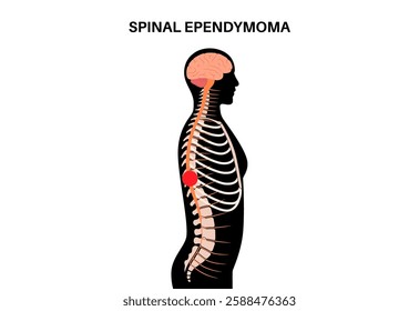 Spinal ependymoma poster. Intramedullary neoplasm in the male silhouette. Glial spinal cord tumor. Primary central nervous system disease. Inflammation in the brain or spinal cord vector illustration