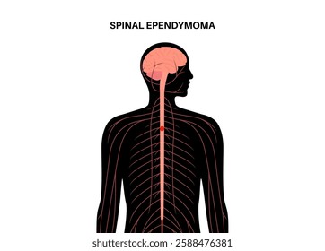 Spinal ependymoma poster. Intramedullary neoplasm in the male silhouette. Glial spinal cord tumor. Primary central nervous system disease. Inflammation in the brain or spinal cord vector illustration