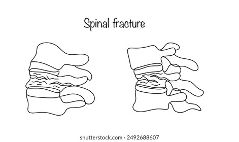 Spinal fracture. A bone injury that affects one or more vertebrae. Drawing a violation of the integrity of the vertebra. Cracks in the spine. Vector illustration.