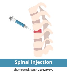 Spinal injection. Spinal Injections can be performed to diagnose the source of pain or as a treatment to relieve pain. Syringe injection into spinal disk.Treatment of back pain or other pathology.